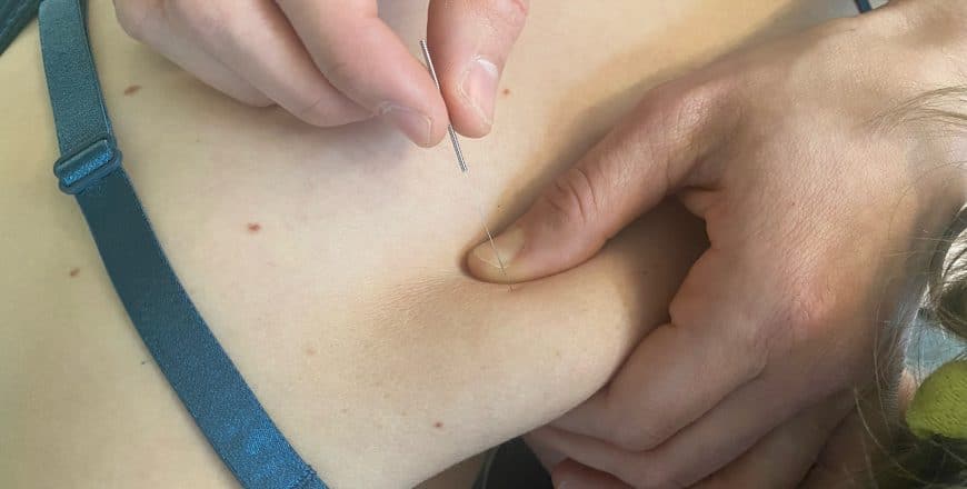 Een vrouw die dry needling-therapie ondergaat waarbij een naald in haar rug wordt ingebracht. AQUS Learning