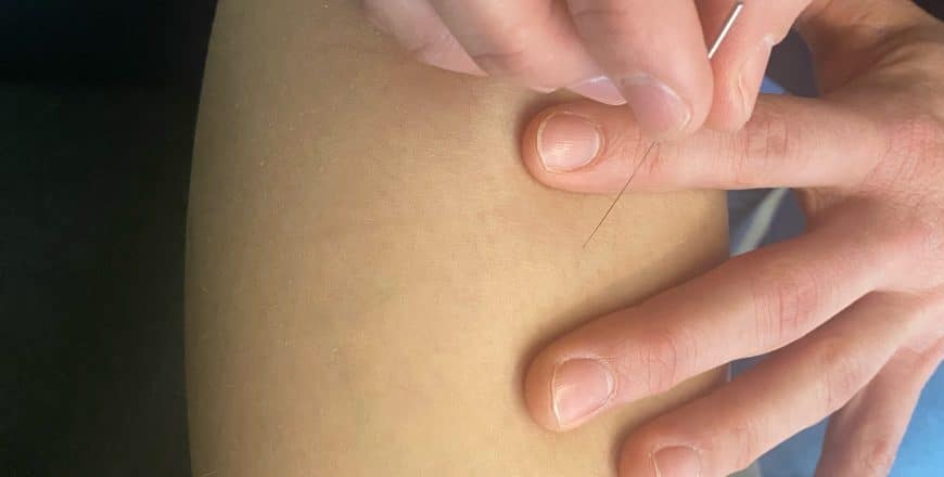 Een persoon die een dry needling-behandeling op zijn arm krijgt. AQUS Learning