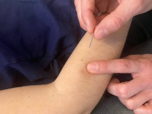 Dry Needling wordt uitgevoerd door een naald in de arm van een persoon te steken. AQUS Learning
