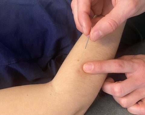 Dry Needling wordt uitgevoerd door een naald in de arm van een persoon te steken. AQUS Learning