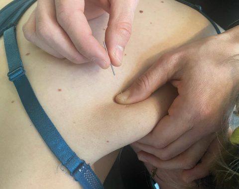 Een vrouw die dry needling-therapie ondergaat waarbij een naald in haar rug wordt ingebracht. AQUS Learning
