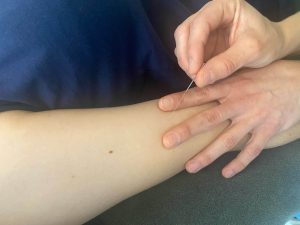 Een persoon die dry needling op iemands arm uitvoert. AQUS Learning