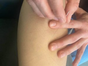 Een persoon die een dry needling-behandeling op zijn arm krijgt. AQUS Learning